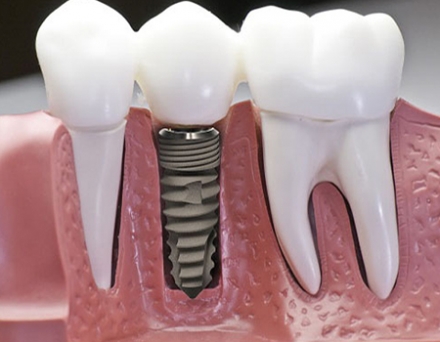 Trồng răng Implant – Công nghệ đột phá của ngành nha khoa