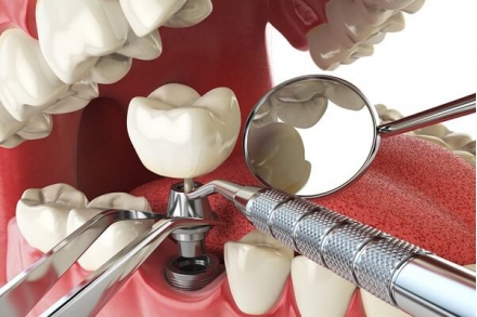 Những lưu ý khi cắm ghép răng Implant kỹ thuật số DIO